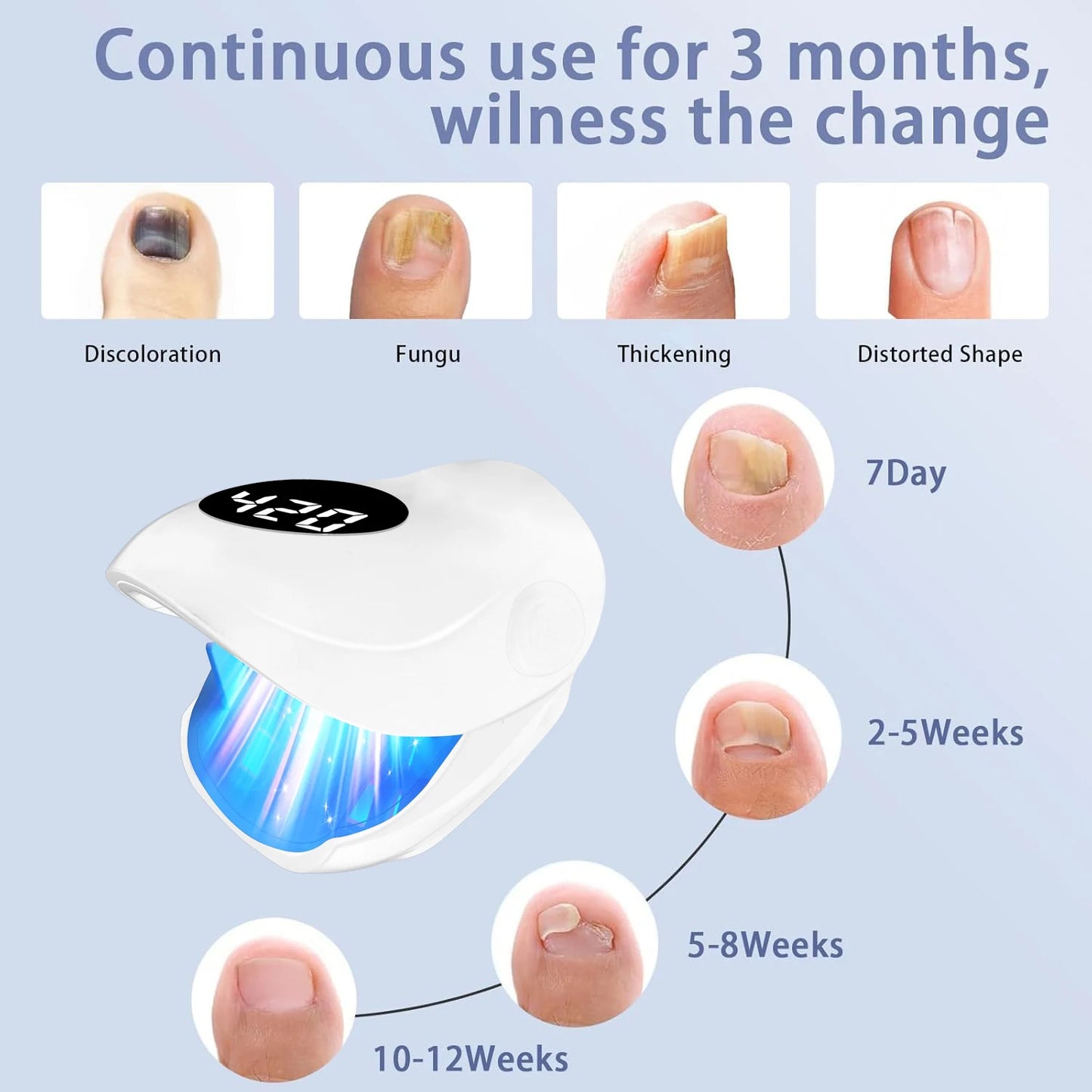 USB Charging Nail Fungus Treatment Device - 940nm Infrared & 500nm Blue Light LED Laser